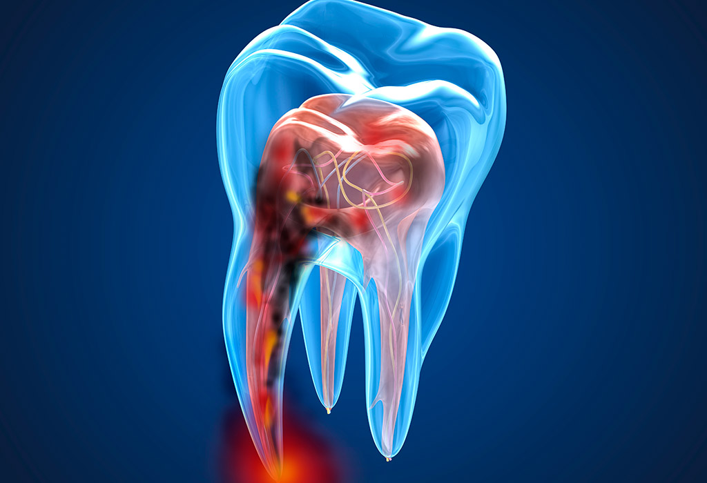 Endodoncia en Castelldefels