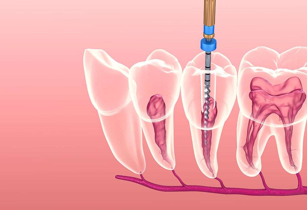 Endodoncia en Castelldefels