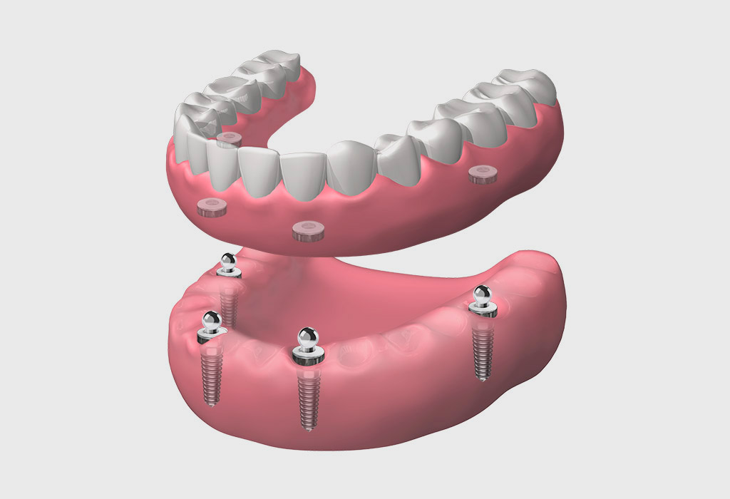 Implantes dentales en Castelldefels