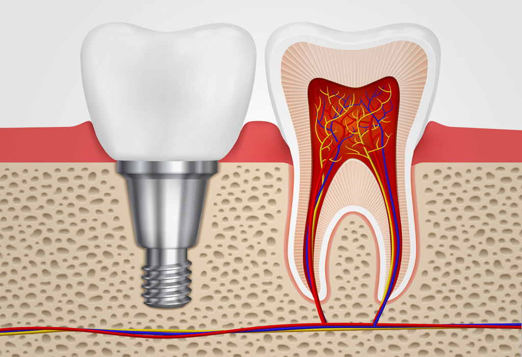 Implantes dentales cortos en Castelldefels