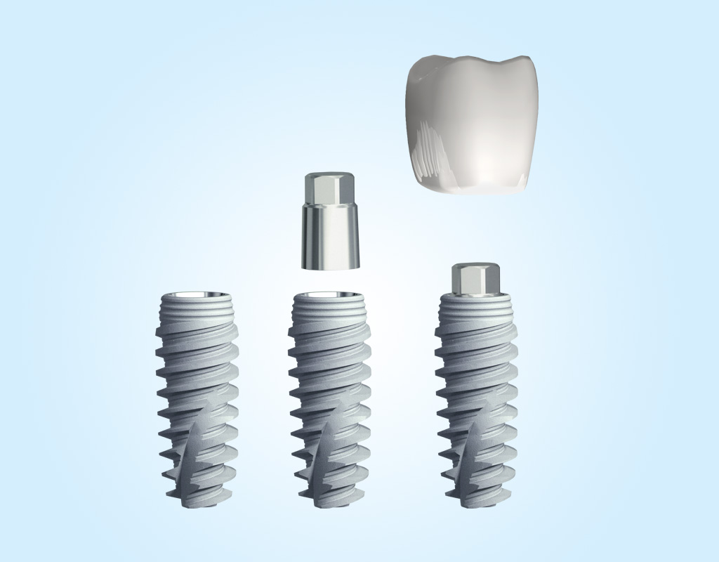 Implantes dentales en Castelldefels