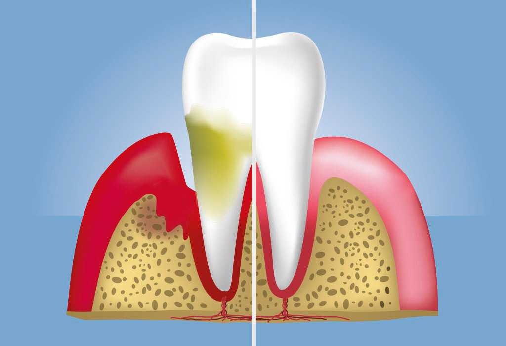 Periodoncia en Castelldefels