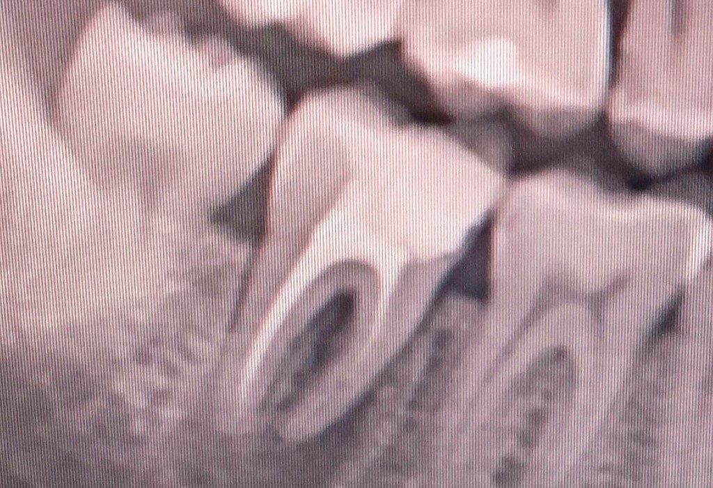 Endodoncia en Castelldefels